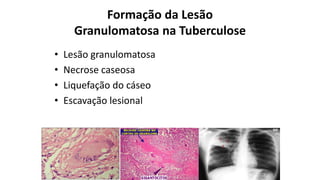 Formação da LesãoGranulomatosana Tuberculose 
•Lesão granulomatosa 
•Necrose caseosa 
•Liquefação do cáseo 
•Escavação lesional  