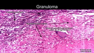 Granuloma  