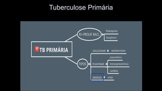 Tuberculose Primária  
