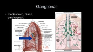 Ganglionar 
•mediastínico, hilar e paratraqueal;  