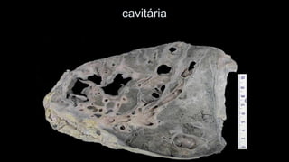 cavitária  