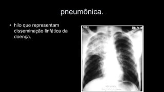 •hilo que representam disseminação linfática da doença. 
pneumônica.  