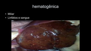 hematogênica 
•Miliar 
•Linfátios e sangue  