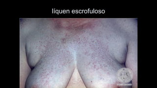 líquen escrofuloso  