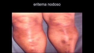 eritema nodoso  