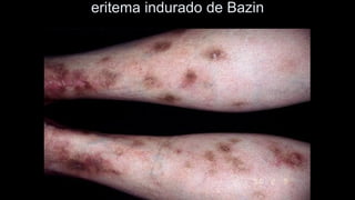 eritema indurado de Bazin  