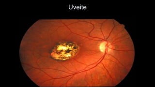 Uveite  