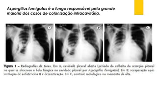 Aspergillusfumigatusé o fungo responsável pela grande maioria dos casos de colonização intracavitária.  