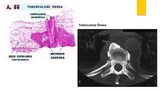 Tuberculose Óssea  