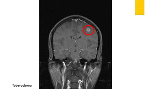 Tuberculoma  