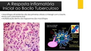 •Macrófagos alíresidentes são das primeiras células a interagir com o bacilo. 
•Inicio com crescimento livre 
•Multiplicação dentro dos fagossomasdos macrófagos 
A Resposta InflamatóriaInicial ao Bacilo Tuberculoso  