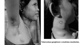 Tuberculose ganglionar e cicatrizes resultantes.  