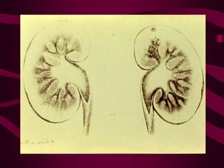 Tuberculosis 1