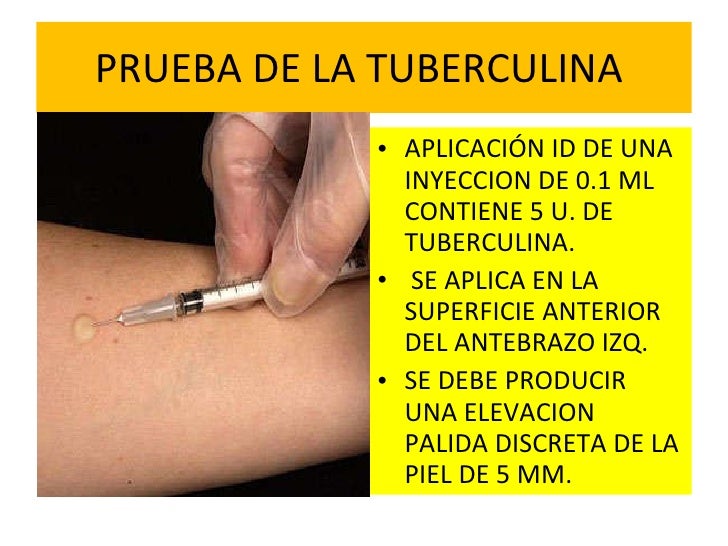 Tuberculosis Tuberculosis