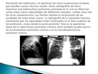 Formación de tubérculos y la aparición de otras expansiones tisulares que pueden causar necrosis tisular. Estas radiografías de tórax muestran una tuberculosis pulmonar avanzada en la cual se observan varias áreas claras (opacidades) de diferentes tamaños, unidas unas con las otras (coalescencia). Las flechas señalan la localización de las cavidades de estas áreas claras. La radiografía de la izquierda muestra claramente que las opacidades están localizadas en el área superior de los pulmones, vistas desde la parte posterior. Esta es la apariencia típica de la tuberculosis pulmonar crónica, pero también puede ocurrir en la histiocitosis pulmonar crónica y en la coccidioidomicosis pulmonar crónica.