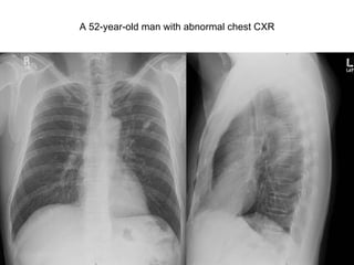 20729054 A 52-year-old man with abnormal chest CXR 