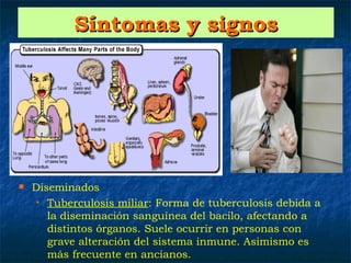 Síntomas y signos




   Diseminados
     • Tuberculosis miliar: Forma de tuberculosis debida a

       la diseminación sanguínea del bacilo, afectando a
       distintos órganos. Suele ocurrir en personas con
       grave alteración del sistema inmune. Asimismo es
       más frecuente en ancianos.
 