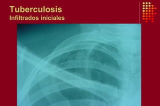 Tuberculosis
Infiltrados iniciales
 