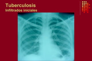 Tuberculosis
Infiltrados iniciales
 