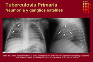 Tuberculosis Primaria
Neumonía y ganglios satélites
Niño de 2 años, aplanamiento de la curva pondoestatural, primo tosedor, apariencia delgada y no acorde
con su edad, fiebre, linfadenopatía cervical prominente, auscultación normal.
 