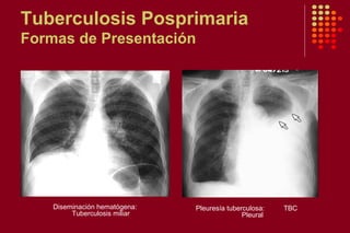 Tuberculosis Posprimaria
Formas de Presentación
Pleuresía tuberculosa: TBC
Pleural
Diseminación hematógena:
Tuberculosis miliar
 