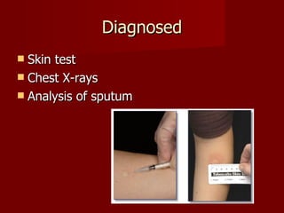 Diagnosed Skin test Chest X-rays Analysis of sputum 