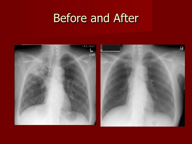 How to Read a Tuberculosis Skin Test: 9 Steps How to Read a Tuberculosis Skin Test: 9 Steps