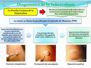 Diagnóstico de la Tuberculosis
                                                  Muestra si la persona ha sido infectada con
       La Prueba Cutánea de la                    las bacterias causantes de la tuberculosis.
             Tuberculina                                 Hay varias clases de pruebas.



              La mejor se llama la prueba por el método de Mantoux PPD.


Inyección intradérmica en
     la cara ventral del
                                                                          Aparecerá en el punto de
   antebrazo de 0,1 cc de           Una jeringa del tipo
                                                                          la inyección una pápula
 líquido, que contiene un         insulina y una aguja de
                                                                          que desaparece en pocos
   extracto de cultivo de        bisel corto, calibre 26-27.
                                                                                  minutos
bacilos tuberculosos 2 UT
    de tuberculina PPD
 