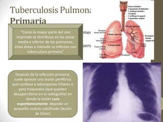 Tuberculosis Pulmonar
Primaria
“Es aquella que aparece consecutivamente a la infección inicial por el
bacilo tuberculoso”
A menudo se observa en niños y en personas con VIH”
“Como la mayor parte del aire
inspirado se distribuye en las zonas
media e inferior de los pulmones,
estas áreas a menudo se infectan con
tuberculosis primaria”
Después de la infección primaria,
suele aprecer una lesión periférica
que conlleva a adenopatías hiliares o
para traqueales (que pueden
desapercibirse en la radiografía) en
donde la lesión cura
espontaneamente dejando un
pequeño nodulo calcificado (lesión
de Ghon)
 