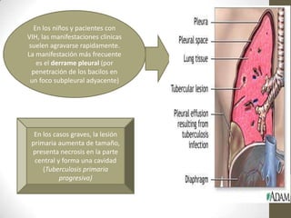 En los niños y pacientes con
VIH, las manifestaciones clinicas
suelen agravarse rapidamente.
La manifestación más frecuente
es el derrame pleural (por
penetración de los bacilos en
un foco subpleural adyacente)
En los casos graves, la lesión
primaria aumenta de tamaño,
presenta necrosis en la parte
central y forma una cavidad
(Tuberculosis primaria
progresiva)
 