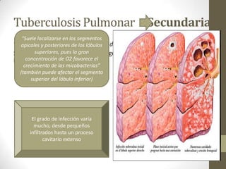 Tuberculosis Pulmonar Secundaria
“Es también llamada Posprimaria, de reactivación o de tipo adulto.
Se debe a la reactivación endógena de una infección tuberculosa
latente”
“Suele localizarse en los segmentos
apicales y posteriores de los lóbulos
superiores, pues la gran
concentración de O2 favorece el
crecimiento de las micobacterias”
(también puede afectar el segmento
superior del lóbulo inferior)
El grado de infección varía
mucho, desde pequeños
infiltrados hasta un proceso
cavitario extenso
 