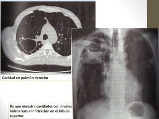 Cavidad en pulmón derecho
Rx que muestra cavidades con niveles
hidroareos e infiltración en el lóbulo
superior
 