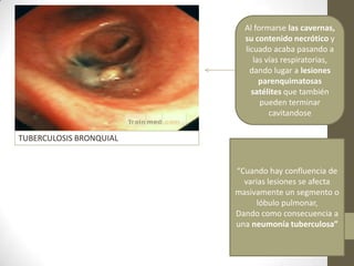 Al formarse las cavernas,
su contenido necrótico y
licuado acaba pasando a
las vías respiratorias,
dando lugar a lesiones
parenquimatosas
satélites que también
pueden terminar
cavitandose
“Cuando hay confluencia de
varias lesiones se afecta
masivamente un segmento o
lóbulo pulmonar,
Dando como consecuencia a
una neumonía tuberculosa”
TUBERCULOSIS BRONQUIAL
 