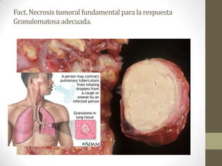 Fact.Necrosistumoralfundamentalparalarespuesta
Granulomatosaadecuada.
 