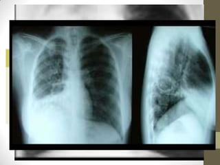 Percusión
• hipersonoridad
auscultación
• Soplo cavitario
• Gorgoteo
• Pectoriloquia
áfona
Rx
• Hiperclaridad
bien definida
• En canas o
algodón de
agusto
 