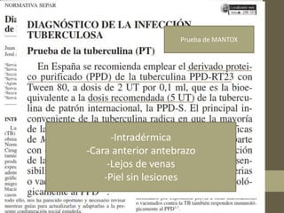 -Intradérmica
-Cara anterior antebrazo
-Lejos de venas
-Piel sin lesiones
Prueba de MANTOX
 