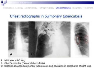 Chest radiographs in pulmonary tuberculosis
Introduction Etiology Epidemiology Pathophysiology Clinical features Diagnosis Treatment
Pathogenesis of Tuberculosis
A. Infiltrates in left lung
B. Ghon’s complex (Primary tuberculosis)
C. Bilateral advanced pulmonary tuberculosis and cavitation in apical area of right lung
A BC
 