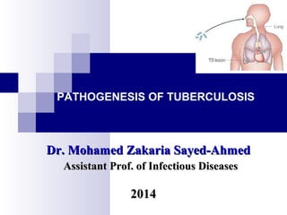 PATHOGENESIS OF TUBERCULOSIS
Assistant Prof. of Infectious DiseasesAssistant Prof. of Infectious Diseases
20142014
Dr. Mohamed Zakaria Sayed-AhmedDr. Mohamed Zakaria Sayed-Ahmed
 
