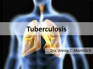 Tuberculosis
Dra. Aleida C. Montilla R.
 
