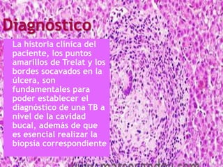 Diagnóstico
La historia clínica del
paciente, los puntos
amarillos de Trelat y los
bordes socavados en la
úlcera, son
fundamentales para
poder establecer el
diagnóstico de una TB a
nivel de la cavidad
bucal, además de que
es esencial realizar la
biopsia correspondiente
 