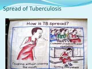 Spread of Tuberculosis
 