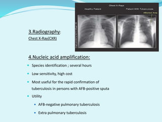 3.Radiography:
Chest X-Ray(CXR)
4.Nucleic acid amplification:
 Species identification ; several hours
 Low sensitivity, high cost
 Most useful for the rapid confirmation of
tuberculosis in persons with AFB-positive sputa
 Utility
 AFB-negative pulmonary tuberculosis
 Extra pulmonary tuberculosis
 