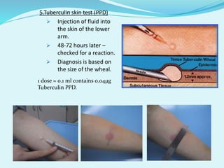5.Tuberculin skin test (PPD)
 Injection of fluid into
the skin of the lower
arm.
 48-72 hours later –
checked for a reaction.
 Diagnosis is based on
the size of the wheal.
1 dose = 0.1 ml contains 0.04µg
Tuberculin PPD.
 