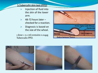 5.Tuberculin skin test (PPD)
 Injection of fluid into
the skin of the lower
arm.
 48-72 hours later –
checked for a reaction.
 Diagnosis is based on
the size of the wheal.
1 dose = 0.1 ml contains 0.04µg
Tuberculin PPD.
 