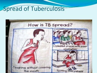 Spread of Tuberculosis
 