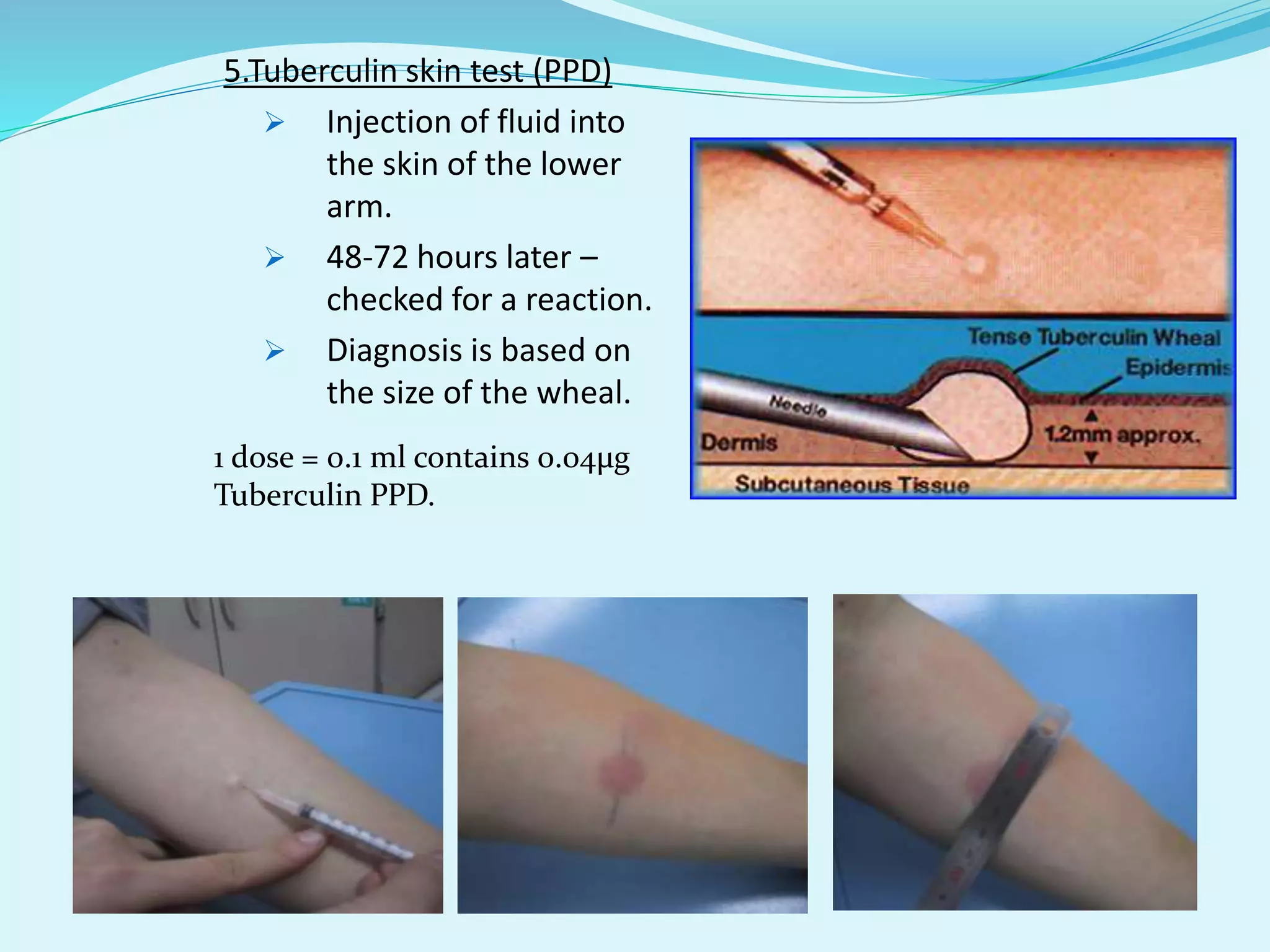 Ppd Injection Dose Tuberculosis | PPTX
