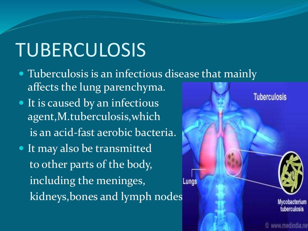 tuberculosis presentation slideshare
