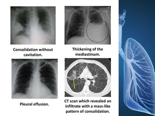 Consolidation without
cavitation.
Pleural effusion.
Thickening of the
mediastinum.
CT scan which revealed an
infiltrate with a mass-like
pattern of consolidation.
 