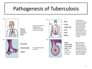 Pathogenesis of Tuberculosis
32
 