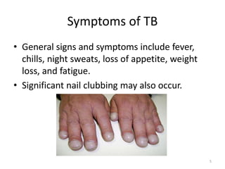 Symptoms of TB
• General signs and symptoms include fever,
chills, night sweats, loss of appetite, weight
loss, and fatigue.
• Significant nail clubbing may also occur.
5
 